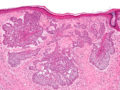 basalcell-carcinoma-hud
