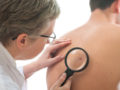 Läkare undersöker malignt melanom
