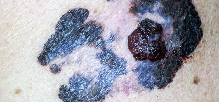 Bild på malignt melanom