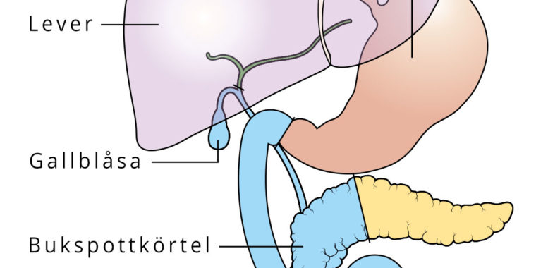 Illustration av inre organ där delar som opereras bort vid bukspottkörtelcancer är markerade.