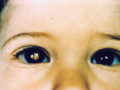 Retinoblastoma