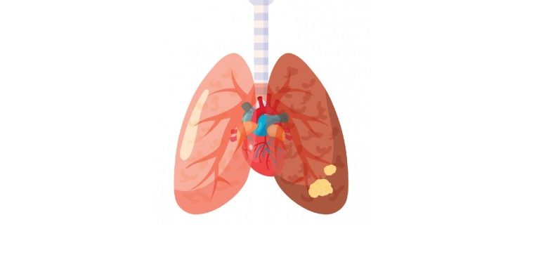 Lungcancer illustration